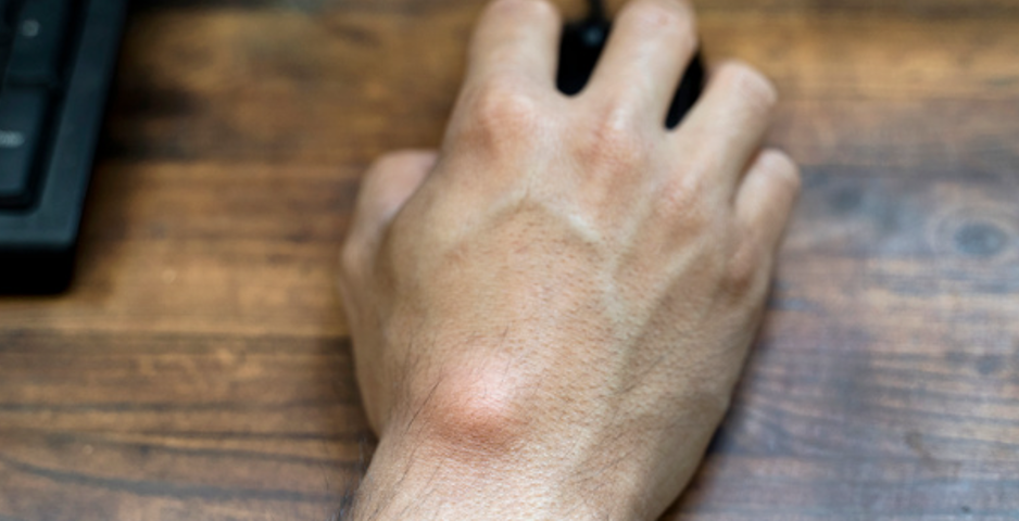 Ganglion kisti