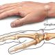 ganglion kisti