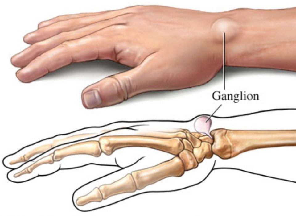 ganglion kisti