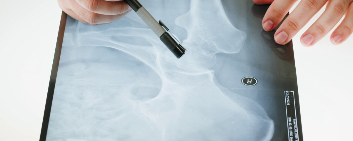 kalça avasküler nekrozu