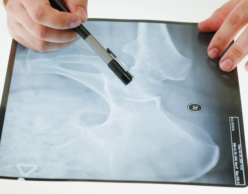 kalça avasküler nekrozu